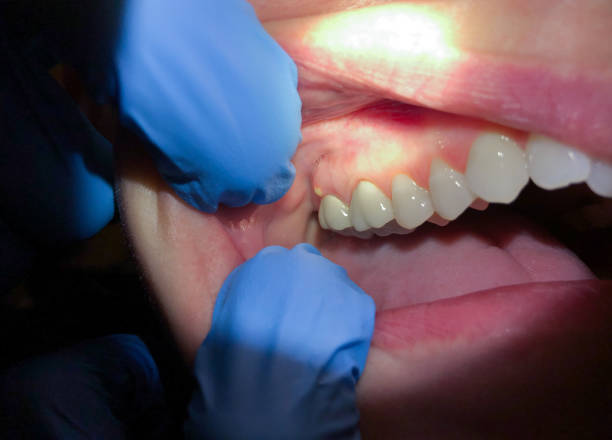 Best Emergency Dental Care for Broken or Chipped Teeth in Spring Arbor, MI