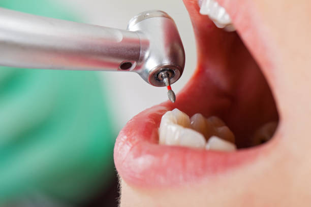 Best Urgent Care for Lost Fillings or Crowns in Spring Arbor, MI